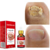 Nail Infections Treatment Serum